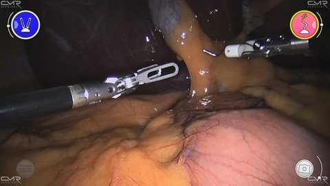 An endoscopic view inside the abdomen during robotic gallbladder surgery: a metal grasper enters from the left and a hooked instrument from the upper right over yellow and pink tissue, with round console icons in the corners and small CMR Surgical marks.