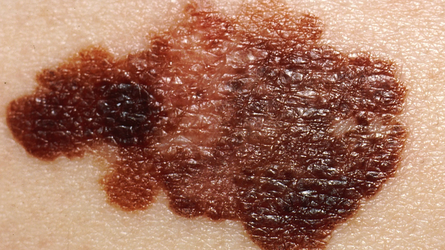 Close-up photograph of a melanoma on pale skin: an irregular brown patch with uneven darker areas and a ragged border.